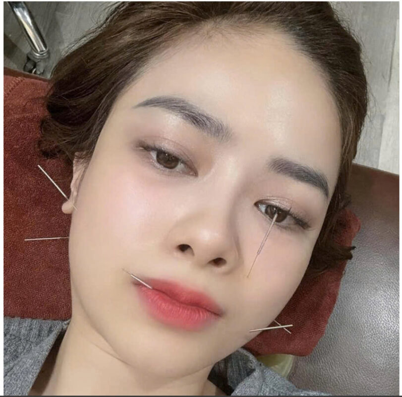 Chữa liệt dây thần kinh số 7 bằng phương pháp Y học cổ truyền- Sao Việt Nam